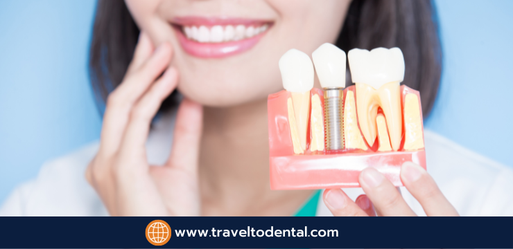 What are full mouth implants? And which clinics in Thailand conducts full mouth dental implants?